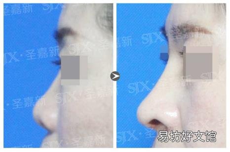 中国最好的下颌角医生张笑天 张笑天整形怎么样
