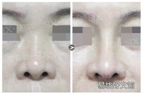 中国最好的下颌角医生张笑天 张笑天整形怎么样