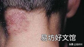 猫癣症状及图片大全(猫癣症状早期图片)
