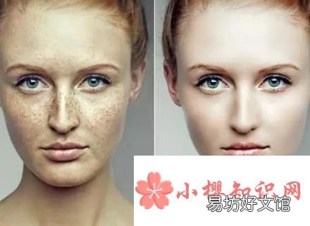 有哪些祛除雀斑的好方法