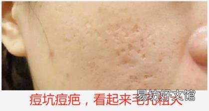 女人毛孔粗大怎么办 女生毛孔粗大