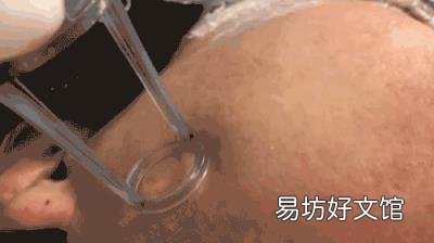横扫痘坑的最牛方法 怎样去痘坑
