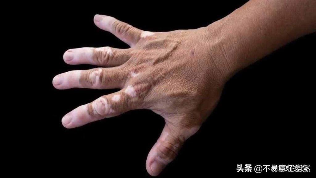 麦克杰逊皮肤怎么变白的 迈克尔杰克逊是怎么变白的