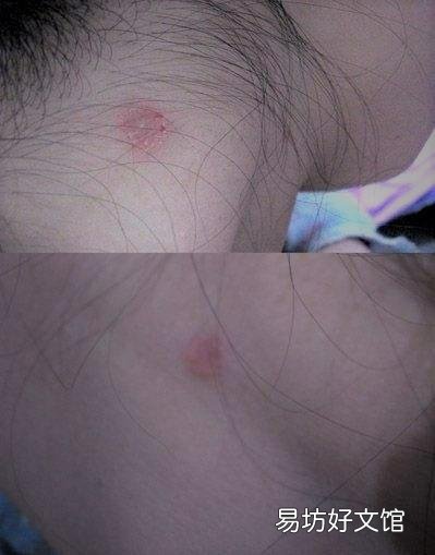 真菌猫藓怎么治疗(真菌猫藓治疗方法)