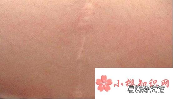 祛剖腹产疤痕哪种好
