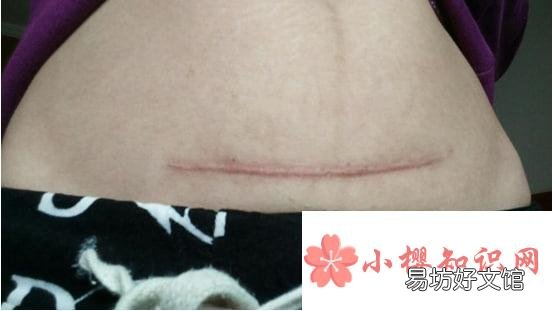 祛剖腹产疤痕哪种好