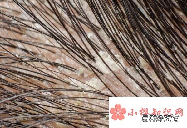 头中间为什么有头皮