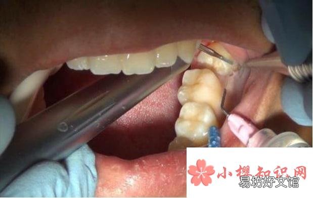 下牙智齿拔了能瘦脸吗