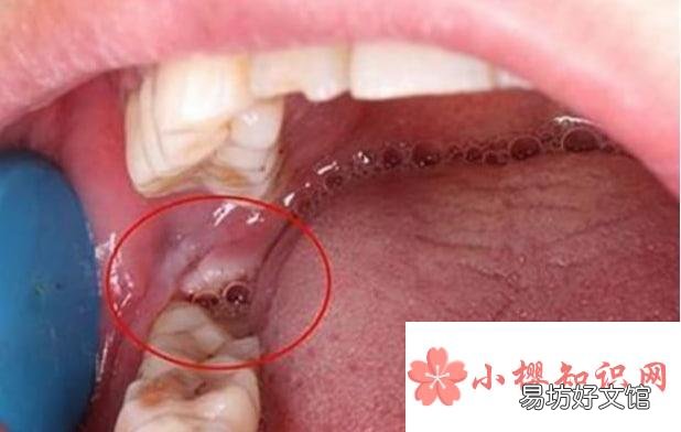 下牙智齿拔了能瘦脸吗