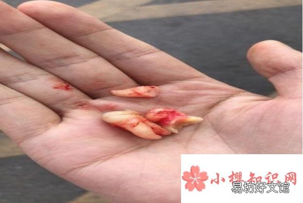 下牙智齿拔了能瘦脸吗