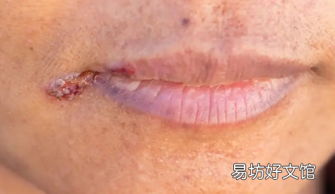 得了唇疱疹永远不能接吻了吗 嘴唇疱疹结痂了可以接吻吗