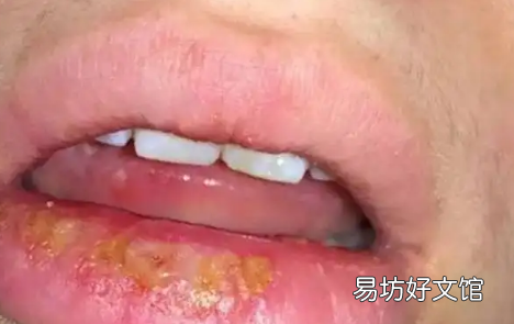 得了唇疱疹永远不能接吻了吗 嘴唇疱疹结痂了可以接吻吗