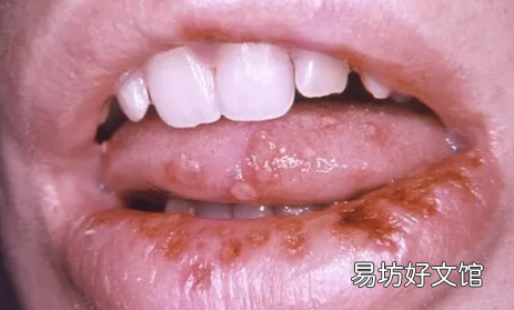 得了唇疱疹永远不能接吻了吗 嘴唇疱疹结痂了可以接吻吗