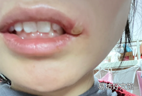 怎么预防嘴唇疱疹反复发作 每隔一段时间嘴唇会起疱疹怎么回事
