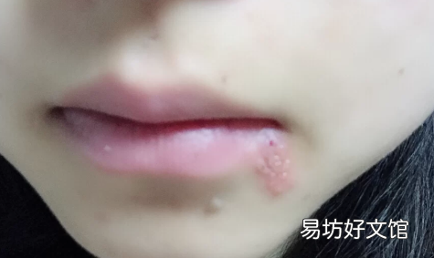 怎么预防嘴唇疱疹反复发作 每隔一段时间嘴唇会起疱疹怎么回事