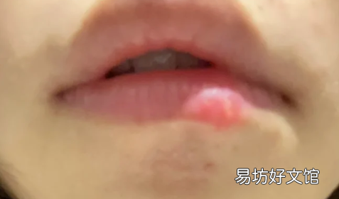 怎么预防嘴唇疱疹反复发作 每隔一段时间嘴唇会起疱疹怎么回事