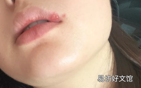 面部疱疹留下凹坑怎么去除 带状疱疹结痂后里面有脓咋办