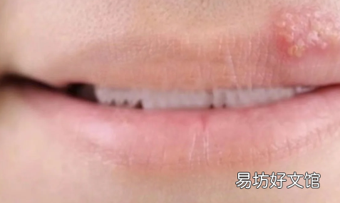 面部疱疹留下凹坑怎么去除 带状疱疹结痂后里面有脓咋办