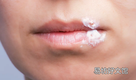 唇疱疹结痂后如何处理 口唇疱疹结痂了怎么好得快
