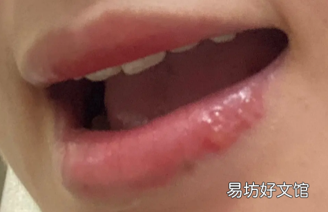 唇疱疹结痂后如何处理 口唇疱疹结痂了怎么好得快