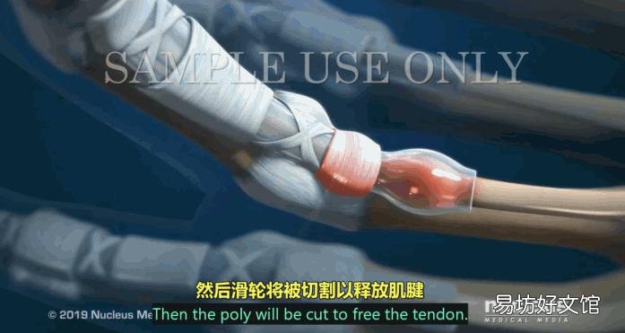 「逃过」能逃过腱鞘炎的年轻人，已经不多了